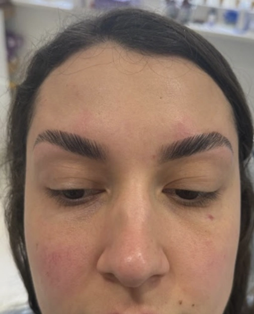 Patient results after facial aesthetics treatment Dublin