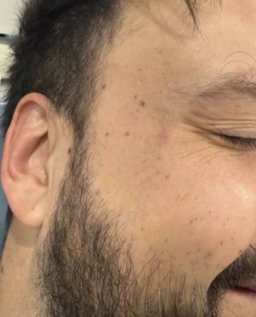 Natural results after facial treatment for male patient Ireland