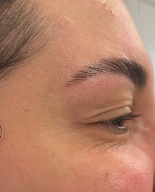Natural anti-wrinkle results — Enhance Dental Ireland