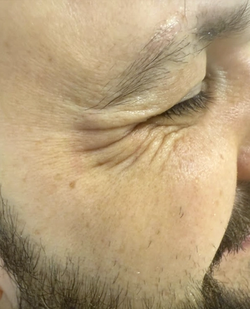 Before anti-wrinkle injections male patient Enhance Dental