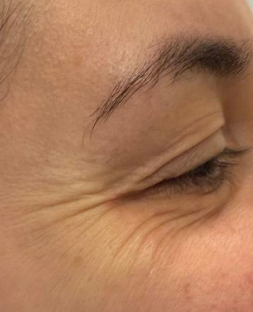Anti-wrinkle treatment before — Enhance Dental Dublin