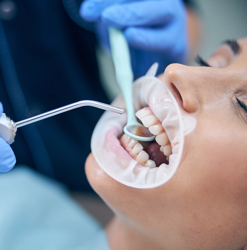 Dental hygienist scale and polish Dublin Enhance Dental