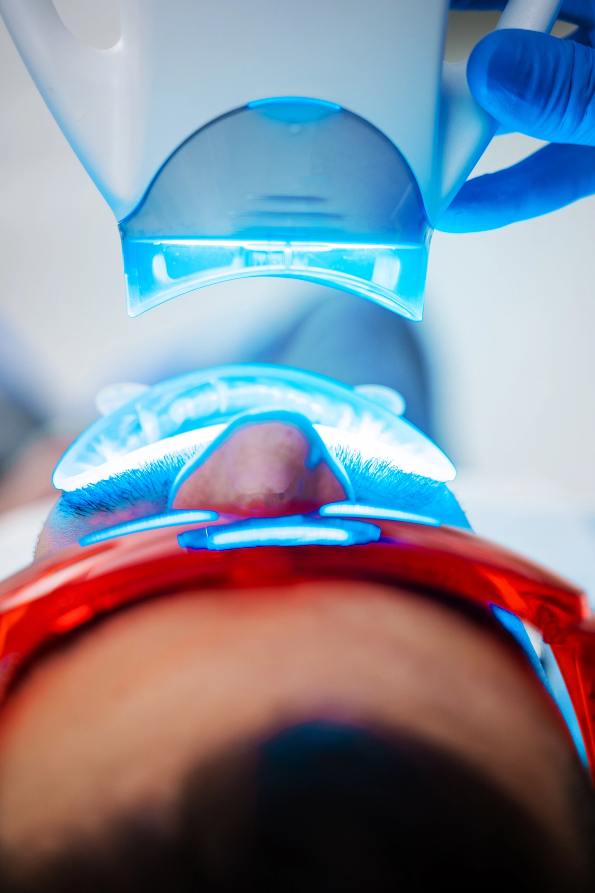 Professional teeth whitening treatment at Enhance Dental Dublin