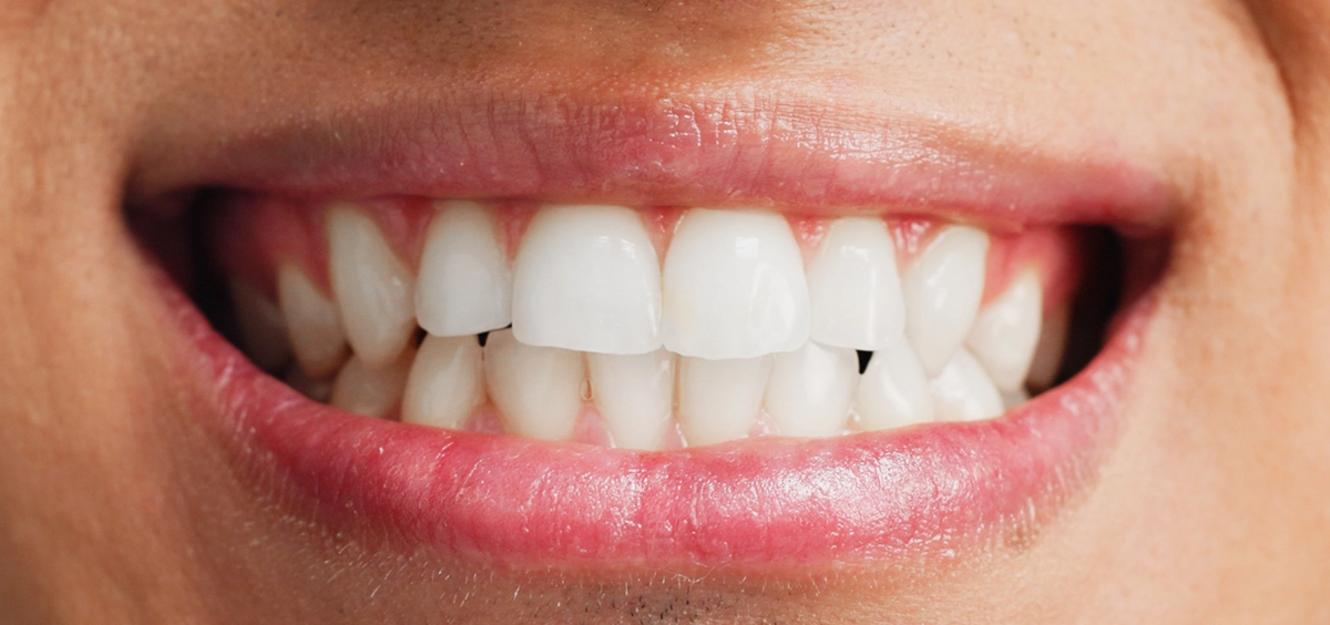 Teeth whitening result — patient 1 — Enhance Dental Dublin