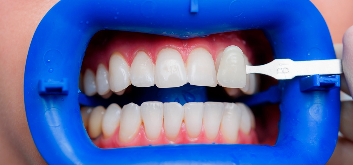 Teeth whitening result — patient 3 — Enhance Dental Dublin